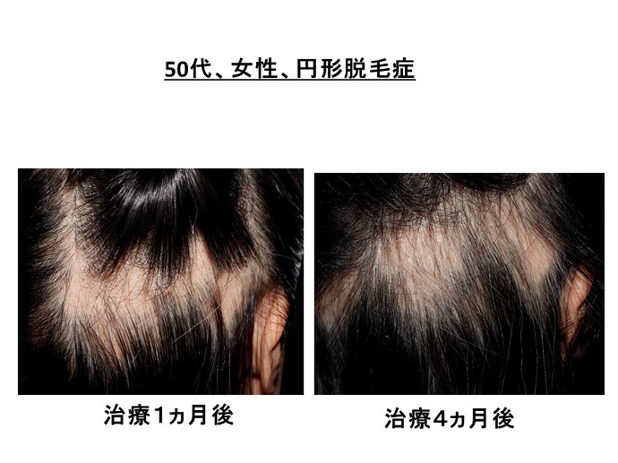 円形脱毛症　病院